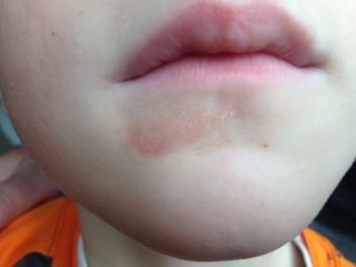 Lip Licker’s Dermatitis: Rash Around the Lips